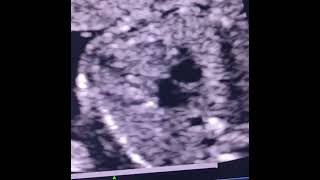 fetal echo showing hypoplastic tv intact septum suggestive of pulmonary atresia intact ivschd [upl. by Zetroc735]