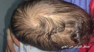 مرض الرأس المستطيلة …Sagittal Synostosis [upl. by Karleen]