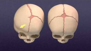 Craniosynostosis  Mayo Clinic [upl. by Marlyn]