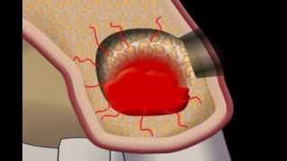 Cyst Removal  Cystektomie [upl. by Myrt516]