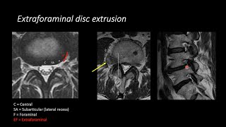 Herniated Disc  Patient Education [upl. by Aidekal]