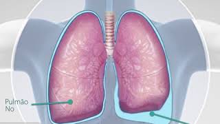 Derrame pleural [upl. by Anyale]