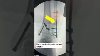 FRACTURA DEL MALEOLO POSTERIOR DEL TOBILLO juancalbornoz shorts fracturadetobillo [upl. by Noirod161]