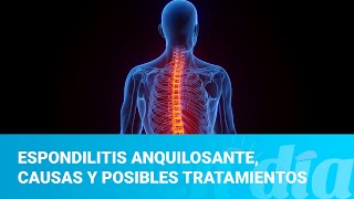 Espondilitis anquilosante causas y posibles tratamientos [upl. by Lucchesi]