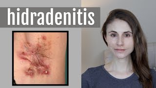 HIDRADENITIS SUPPURATIVA QampA WITH DERMATOLOGIST DR DRAY [upl. by Silverts903]