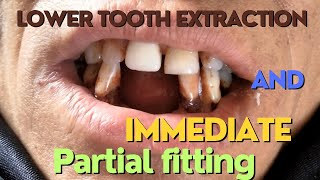 Lower front tooth extraction  urgent replacement  tooth extraction  missing tooth replacement [upl. by Slein]