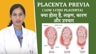 Placenta Previa FAQs By Dr Richa Vaishnav [upl. by Linden788]