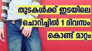 തുടകള്‍ക്ക് ഇടയിലെ ചൊറിച്ചില്‍ 1 ദിവസം കൊണ്ട് മാറ്റാം  Home remedies for inner thigh itching [upl. by Ajay]