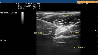 Obturator Nerve Block [upl. by Nakre959]