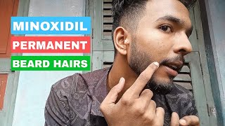 how to manage minoxidil grown beard  🪴 15 din m beard double with minoxidil 😡 minoxidil results [upl. by Atila]