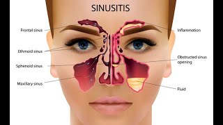 Chronic Sinusitis and just one homeopathic remedy amp 1 dose chronic sinusitis headache UrduHindi [upl. by Eelsel]