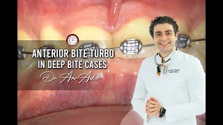 Anterior bite turbo in deep bite casesbonding lower braces How to raise the bite in orthodontics [upl. by Margot]