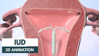 How does an IUD work  3D animation [upl. by Lynnelle]