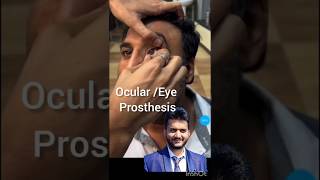 Eye prosthesis ocular prosthesis eye injury vision shorts [upl. by Hofstetter]