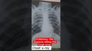 chest xray pneumonia pneumonia treatment medical doctors youtubeshorts [upl. by Iliram]