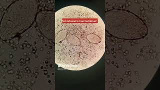 Schistosoma haematobiumSchistosomiasis parasite under microscope parasitology urinalysis [upl. by Enilemme456]