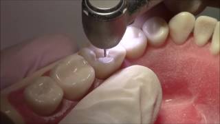 Tutorial on Class I Cavity Preparation Amalgam Restoration  DENTALKART [upl. by Rahs]