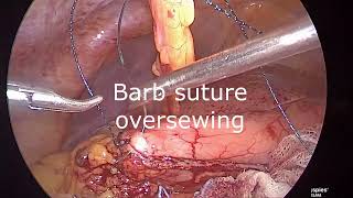 Laparoscopic excision ofGR curve stomach GIST [upl. by Eybbob]