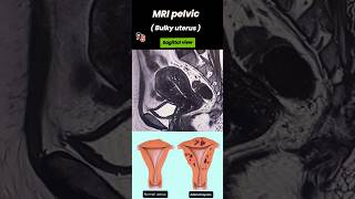 Adenomyosis ll Bulky Uterus ll MRI Pelvis radiology anatomy shorts [upl. by Letnohc55]