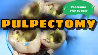 Pulpectomy  Procedure Step By Step  Kedo Square File [upl. by Seilenna]