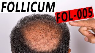 Follicum FOL 005 Anti Hair Loss Treatment UPDATE [upl. by Erdnaek964]