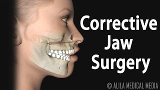 Corrective Jaw Orthognathic Surgery Animation [upl. by Bal]