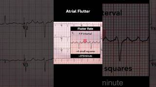 Atrial Flutter ECG Flutter rate [upl. by Tidwell]