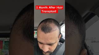 1 Month After Hair Transplant haitransplant besthairtransplant hairdhihairtransplantation [upl. by Peppie]