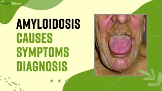 Amyloidosis What Is This Rare Disease Causes Symptoms amp Treatment Of The Amyloidosis [upl. by Utas861]