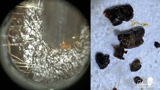 185  Blocked Ear Wax Removal using the WAXscope®️ [upl. by Aubree63]