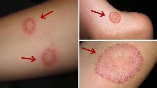 How to Get Rid of Ringworm Overnight  11 Best Home Remedies for Ringworm On Skin [upl. by Enialehs]