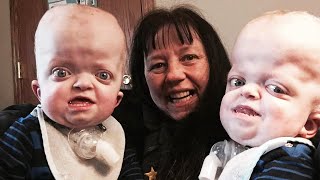 Grandma Adopts Twins With Rare Genetic Disease Says Shes Privileged [upl. by Norward]