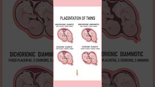 4 Types of twins medically Twin pregnancies pregnant youtubeshorts twins September 4 2024 [upl. by Garcon]