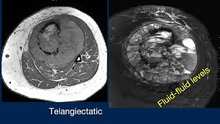 Dr Geoffrey Riley Presents 20 in 10 osteosarcoma [upl. by Dibb]