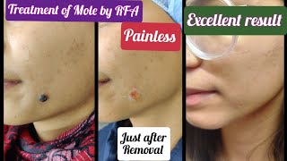 Mole removal by RFA  permanent removal of Melanocytic Nevus Dehradun  Treatment of Mole by RFA [upl. by Ientruoc]