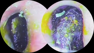 The effective removal of the moist black earwax mixed with orange satisfying earwax 24 [upl. by Aram948]