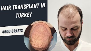 Hair Transplant in Turkey  Hair Transplant 4600 Grafts Process  Hair Transplant hairtransplant [upl. by Narayan]