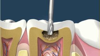 Dental Fillings White Amalgam 1 [upl. by O'Connell]