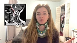 Diagnostic Testing for Craniocervical Instability CCI and Atlantoaxial Instability AAI [upl. by Ednil]