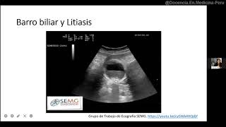 Vesícula biliar Ecografía normal y con litiasis [upl. by Dewey728]