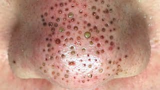 Big Cystic Acne Blackheads Extraction Blackheads amp Milia Whiteheads Removal Pimple Popping [upl. by Suixela]