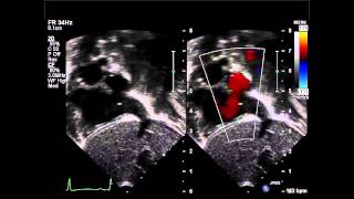 Secundum Atrial Septal Defect Subcostal Saggital View Color Compare [upl. by Rifkin]