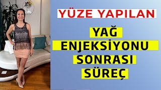 Yüze Yapılan Yağ Enjeksiyonu Sonrası Süreç [upl. by Otxis]