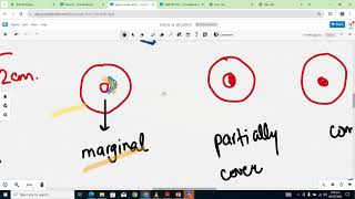 ANTEPARTUM HAEMORRHAGE DISCUSSION [upl. by Nash]