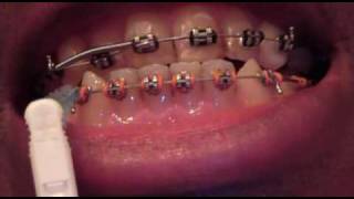 Week 33 in braces  massive movement [upl. by Thatcher]