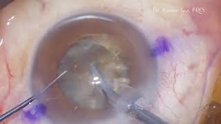 Salzmann corneal degeneration removed during phaco for a dense cataract [upl. by Carolus]