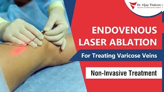 Endovenous Laser Treatment  Advanced Laser Treatment for Varicose Veins  Dr Vijay Thakore [upl. by Brindle]