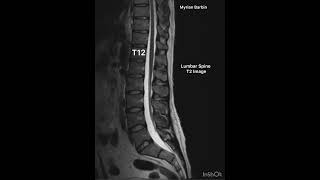 MRI Lumbar Spine anatomy diagnosticradiology mri [upl. by Georgianne273]