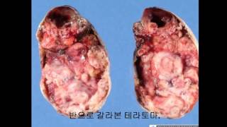 인체의 신비 테라토마약혐주의mystery of teratoma [upl. by Anemix682]