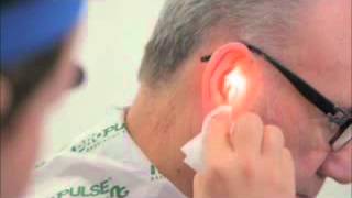 Ear Irrigation with a Propulse NG Ear Irrigatorwmv [upl. by Nanahs]